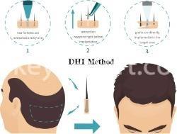 hair transplant dhi method